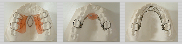 乳歯〜混合歯列の矯正装置 | 茨城県 牛久市 やました歯科・矯正歯科クリニック 矯正歯科