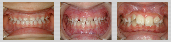 歯並び | 茨城県 牛久市 やました歯科・矯正歯科クリニック 小児歯科