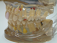 むし歯 | 茨城県 牛久市 やました歯科・矯正歯科クリニック 一般歯科
