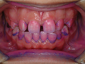 ピンク変色部位：24時間以内のプラーク | 茨城県 牛久市 やました歯科・矯正歯科クリニック 予防歯科