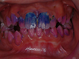 むらさき変色部位：24時間以上のプラーク | 茨城県 牛久市 やました歯科・矯正歯科クリニック 予防歯科